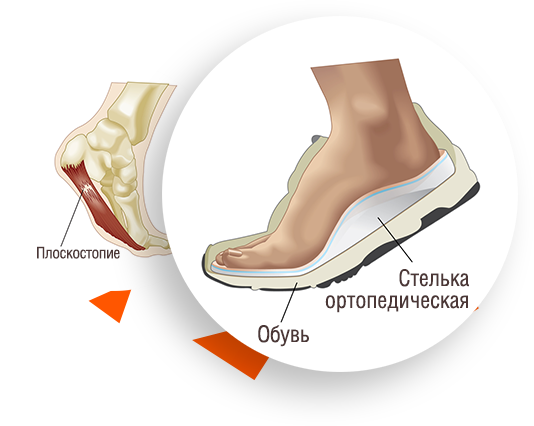 ортопедическая стелька для обуви